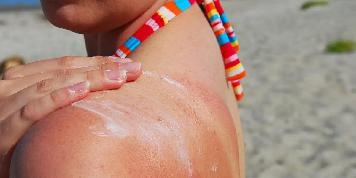 What is Hell's Itch? 7 Ways to Treat Severe Sunburn